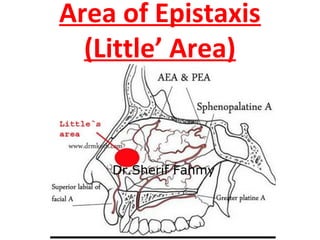 Area of Epistaxis
(Little’ Area)
Dr.Sherif Fahmy
 