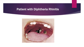Patient with Diphtheria Rhinitis
 
