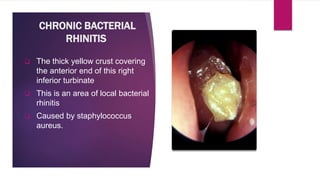 CHRONIC BACTERIAL
RHINITIS
 The thick yellow crust covering
the anterior end of this right
inferior turbinate
 This is an area of local bacterial
rhinitis
 Caused by staphylococcus
aureus.
 