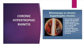 CHRONIC
HYPERTROPHIC
RHINITIS
 
