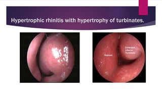 Hypertrophic rhinitis with hypertrophy of turbinates.
 