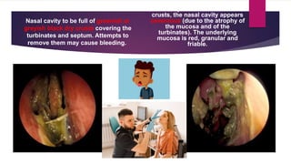 Nasal cavity to be full of greenish or
greyish black dry crusts covering the
turbinates and septum. Attempts to
remove them may cause bleeding.
After a partial removal of the
crusts, the nasal cavity appears
cavernous (due to the atrophy of
the mucosa and of the
turbinates). The underlying
mucosa is red, granular and
friable.
 