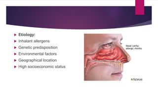  Etiology:
 Inhalant allergens
 Genetic predisposition
 Environmental factors
 Geographical location
 High socioeconomic status
 