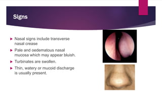 Signs
 Nasal signs include transverse
nasal crease
 Pale and oedematous nasal
mucosa which may appear bluish.
 Turbinates are swollen.
 Thin, watery or mucoid discharge
is usually present.
 