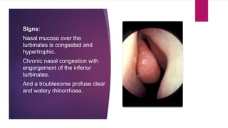 • Signs:
• Nasal mucosa over the
turbinates is congested and
hypertrophic.
• Chronic nasal congestion with
engorgement of the inferior
turbinates.
• And a troublesome profuse clear
and watery rhinorrhoea.
 