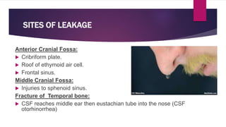 SITES OF LEAKAGE
Anterior Cranial Fossa:
 Cribriform plate.
 Roof of ethymoid air cell.
 Frontal sinus.
Middle Cranial Fossa:
 Injuries to sphenoid sinus.
Fracture of Temporal bone:
 CSF reaches middle ear then eustachian tube into the nose (CSF
otorhinorrhea)
 