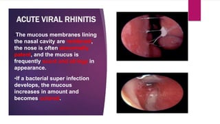 ACUTE VIRAL RHINITIS
•The mucous membranes lining
the nasal cavity are reddened,
the nose is often abnormally
patent, and the mucus is
frequently scant and stringy in
appearance.
•If a bacterial super infection
develops, the mucous
increases in amount and
becomes colored.
 