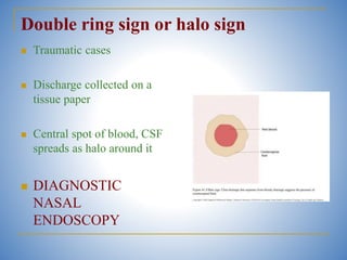 Hello. Sign Csf Nasal and Facial fracture ( under graduate) | PPTX