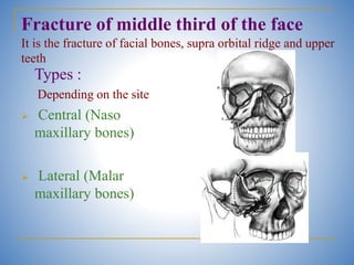Nasal & Facial Injuries ug.............. | PPTX