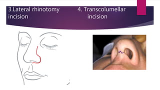 Nasal Rhinotomy Nasal fracture ent ppt | PPTX