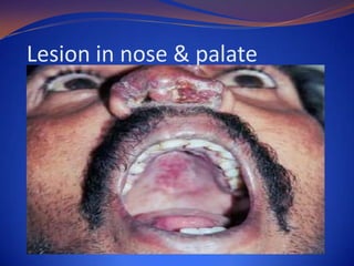 Lesion in nose & palate

 