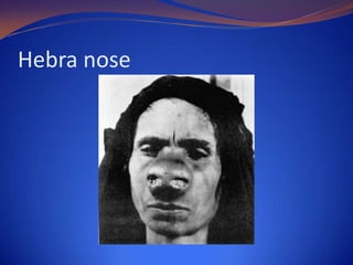 Hebra nose

 