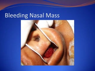 Bleeding Nasal Mass

 