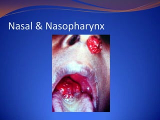 Nasal & Nasopharynx

 