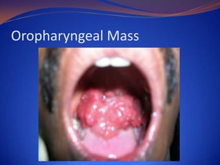 Oropharyngeal Mass

 