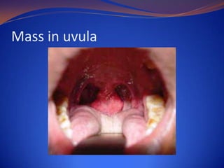 Mass in uvula

 