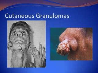 Cutaneous Granulomas

 
