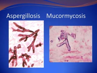 Aspergillosis Mucormycosis

 