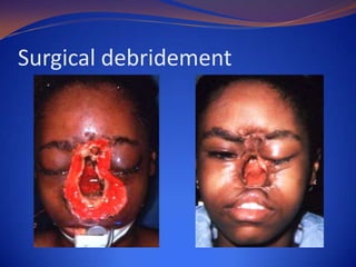 Surgical debridement

 