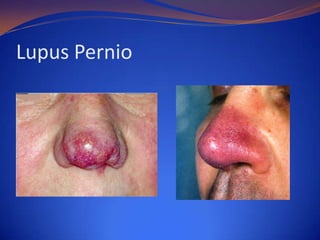 Lupus Pernio

 