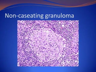 Non-caseating granuloma

 