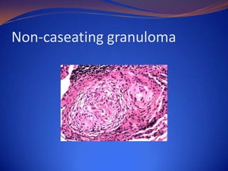 Non-caseating granuloma

 
