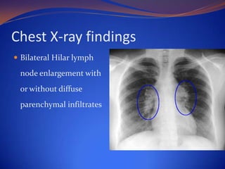Chest X-ray findings
 Bilateral Hilar lymph

node enlargement with
or without diffuse
parenchymal infiltrates

 
