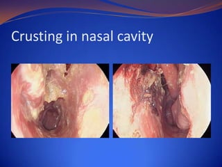 Crusting in nasal cavity

 