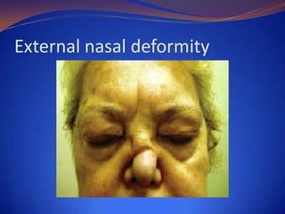 External nasal deformity

 