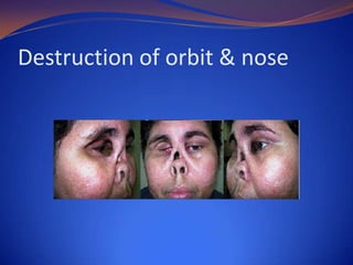 Destruction of orbit & nose

 