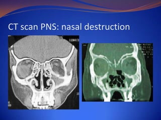 CT scan PNS: nasal destruction

 