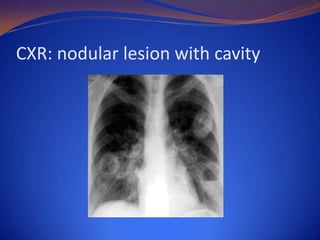 CXR: nodular lesion with cavity

 