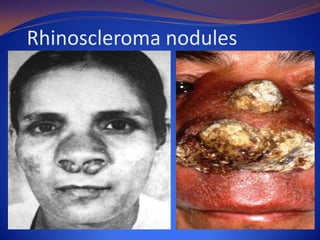 Rhinoscleroma nodules

 