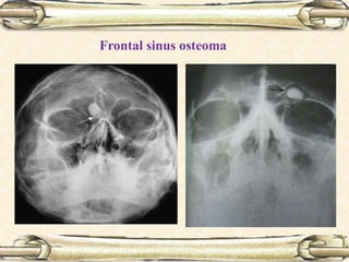 Frontal sinus osteoma
 