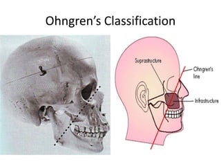 Ohngren’s Classification
 