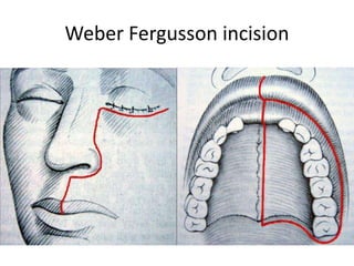 Weber Fergusson incision
 