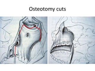 Osteotomy cuts
 