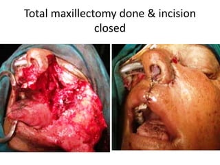 Total maxillectomy done & incision
closed
 