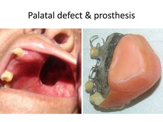 Palatal defect & prosthesis
 