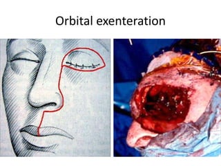 Orbital exenteration
 