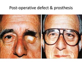 Post-operative defect & prosthesis
 