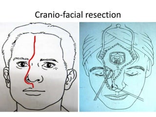 Cranio-facial resection
 