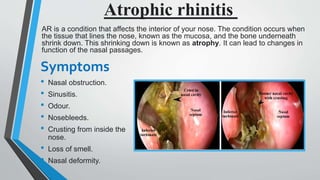 Nasal passage diseases | PPTX