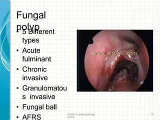 Fungal
polyp• 5 Different
types
• Acute
fulminant
• Chronic
invasive
• Granulomatou
s invasive
• Fungal ball
• AFRS
drtbalu's otolaryngology
online
13
 