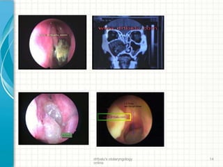 drtbalu's otolaryngology
online
14
 