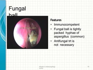 Fungal
ball
Features
• Immunocompetent
• Fungal ball is tightly
packed hyphae of
aspergillus (common)
• Antifungal trt is
not necessary
drtbalu's otolaryngology
online
18
 