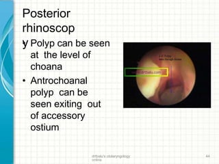 Posterior
rhinoscop
y• Polyp can be seen
at the level of
choana
• Antrochoanal
polyp can be
seen exiting out
of accessory
ostium
drtbalu's otolaryngology
online
44
 