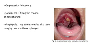 • On posterior rhinoscopy
-globular mass filling the choana
or nasopharynx
-a large polyp may sometimes be also seen
hanging down in the oropharynx.
 