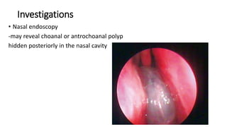 Investigations
• Nasal endoscopy
-may reveal choanal or antrochoanal polyp
hidden posteriorly in the nasal cavity
 