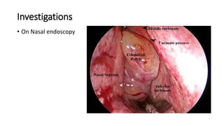 Investigations
• On Nasal endoscopy
 